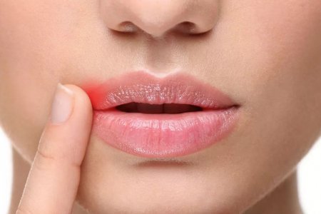 Ангулярный стоматит или заеды в уголках рта - причины и особенности лечения